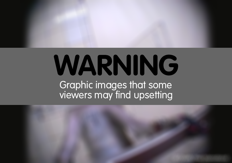 Warning - graphic images that some viewers may find upsetting.